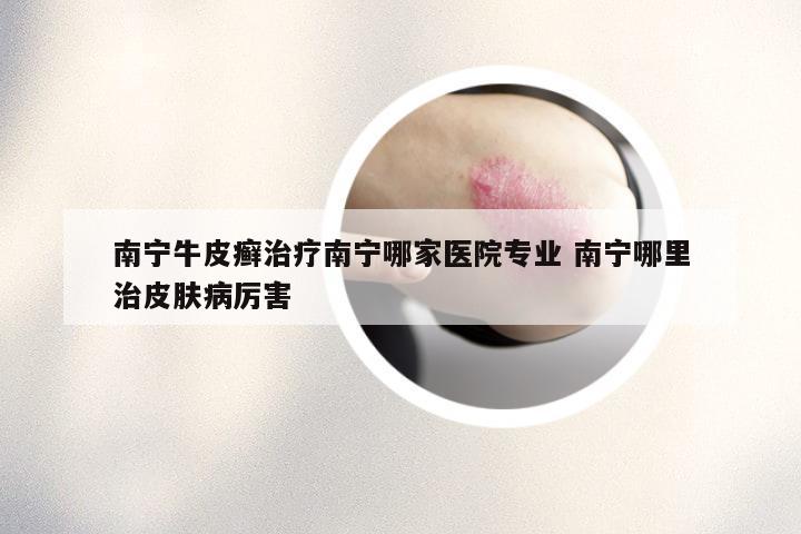 南宁牛皮癣治疗南宁哪家医院专业 南宁哪里治皮肤病厉害