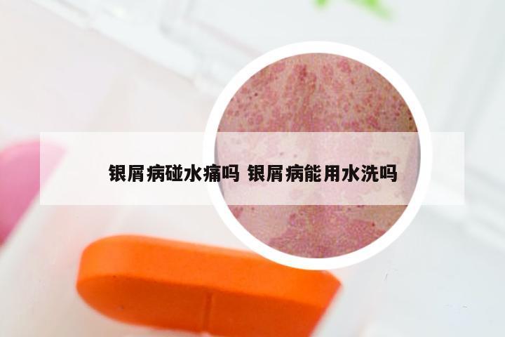 银屑病碰水痛吗 银屑病能用水洗吗