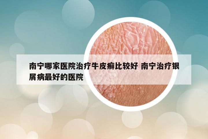 南宁哪家医院治疗牛皮癣比较好 南宁治疗银屑病最好的医院