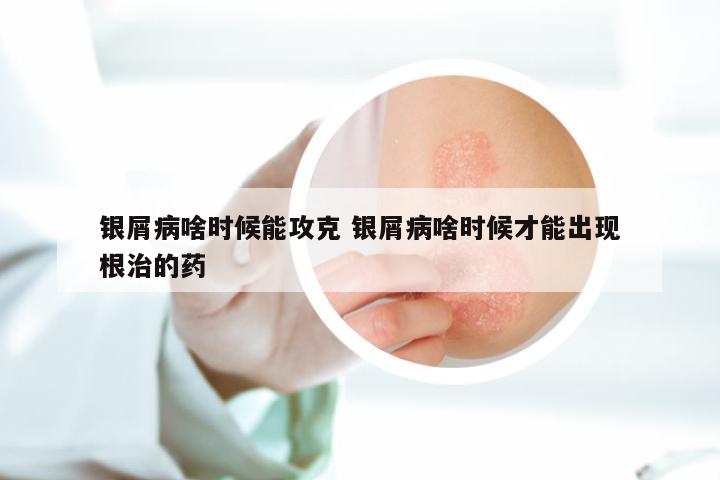 银屑病啥时候能攻克 银屑病啥时候才能出现根治的药