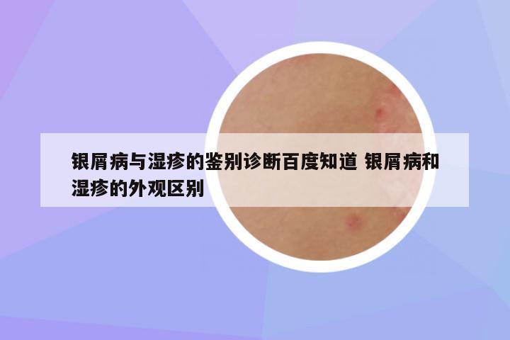 银屑病与湿疹的鉴别诊断百度知道 银屑病和湿疹的外观区别