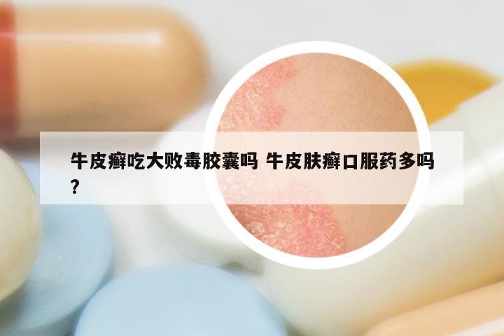 牛皮癣吃大败毒胶囊吗 牛皮肤癣口服药多吗?