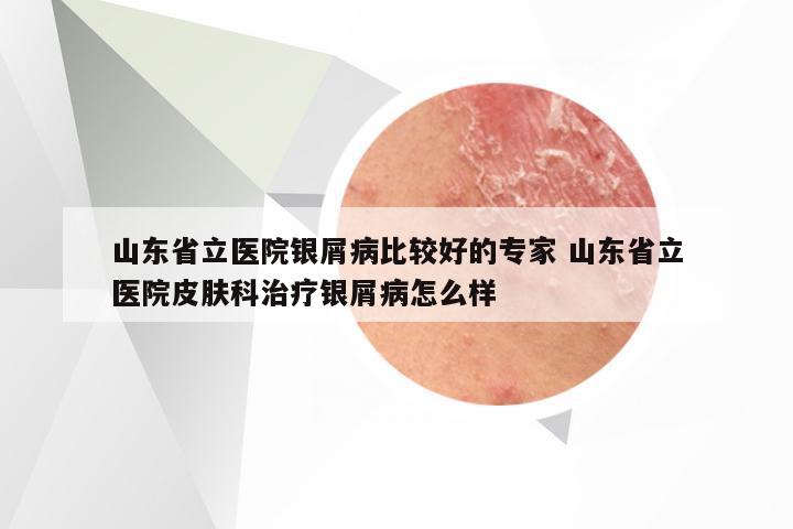 山东省立医院银屑病比较好的专家 山东省立医院皮肤科治疗银屑病怎么样
