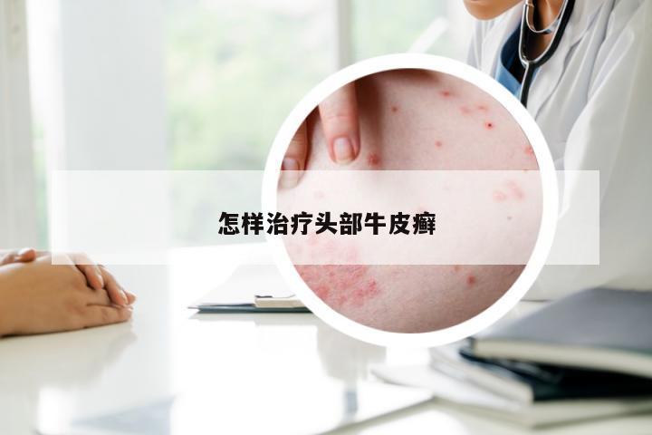 怎样治疗头部牛皮癣