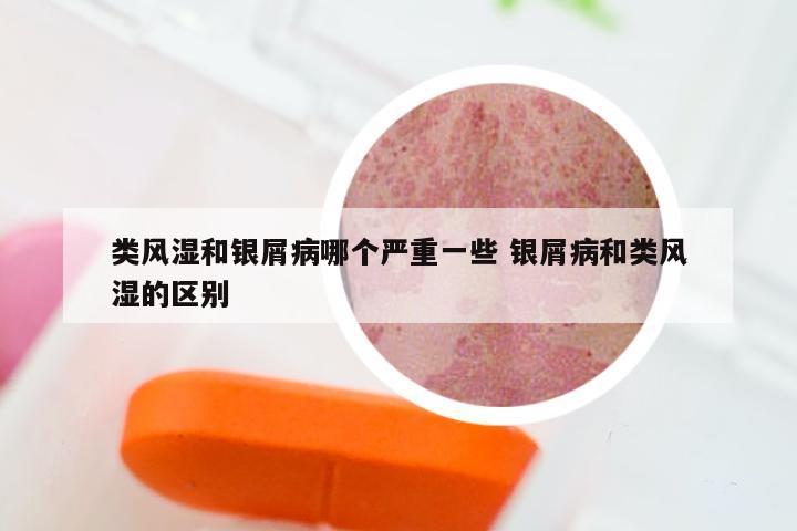 类风湿和银屑病哪个严重一些 银屑病和类风湿的区别