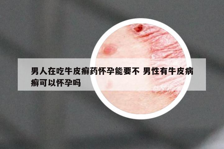 男人在吃牛皮癣药怀孕能要不 男性有牛皮病癣可以怀孕吗