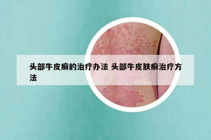 头部牛皮癣的治疗办法 头部牛皮肤癣治疗方法