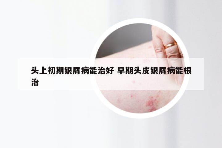 头上初期银屑病能治好 早期头皮银屑病能根治