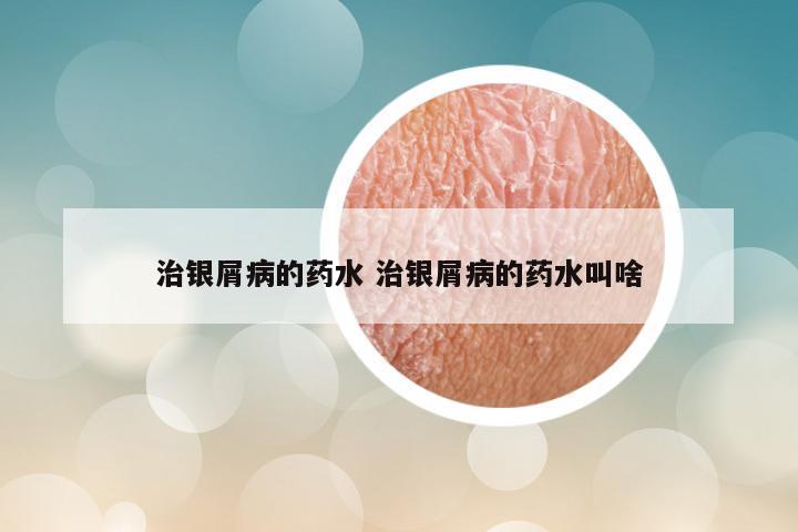 治银屑病的药水 治银屑病的药水叫啥
