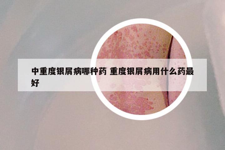 中重度银屑病哪种药 重度银屑病用什么药最好