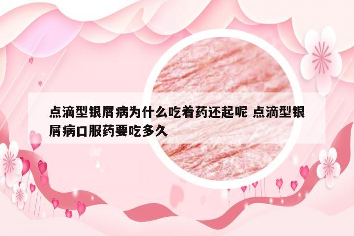 点滴型银屑病为什么吃着药还起呢 点滴型银屑病口服药要吃多久