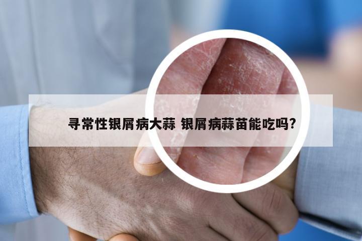 寻常性银屑病大蒜 银屑病蒜苗能吃吗?