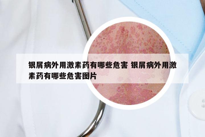 银屑病外用激素药有哪些危害 银屑病外用激素药有哪些危害图片