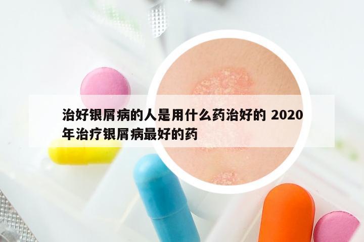 治好银屑病的人是用什么药治好的 2020年治疗银屑病最好的药
