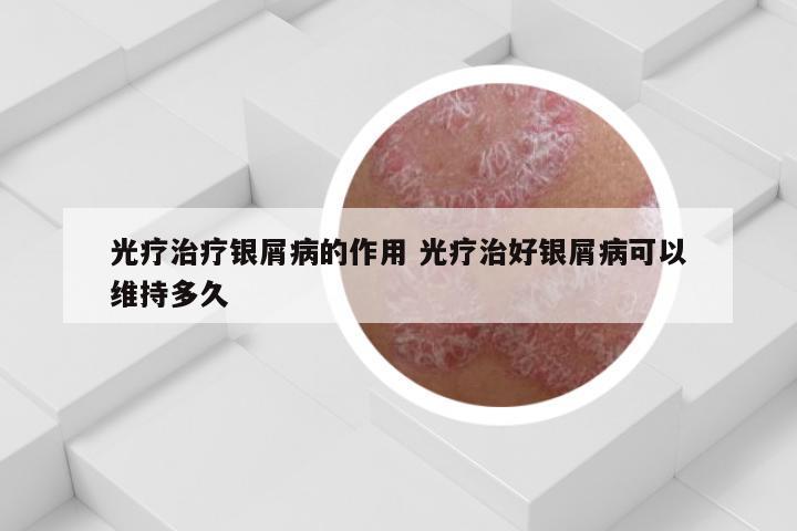 光疗治疗银屑病的作用 光疗治好银屑病可以维持多久