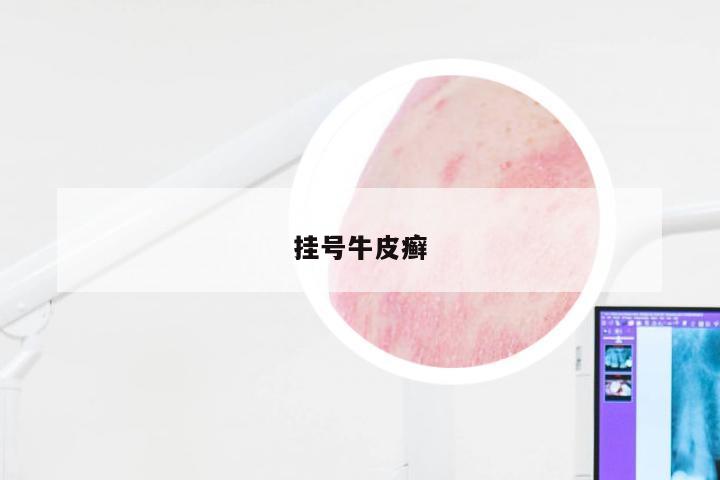 挂号牛皮癣