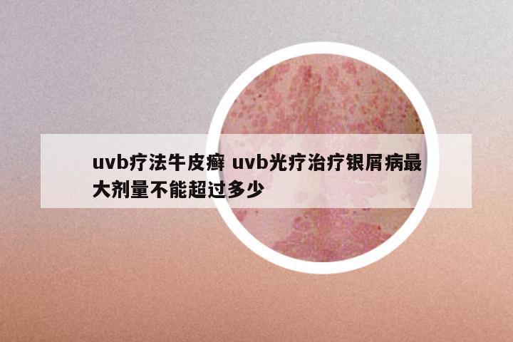 uvb疗法牛皮癣 uvb光疗治疗银屑病最大剂量不能超过多少