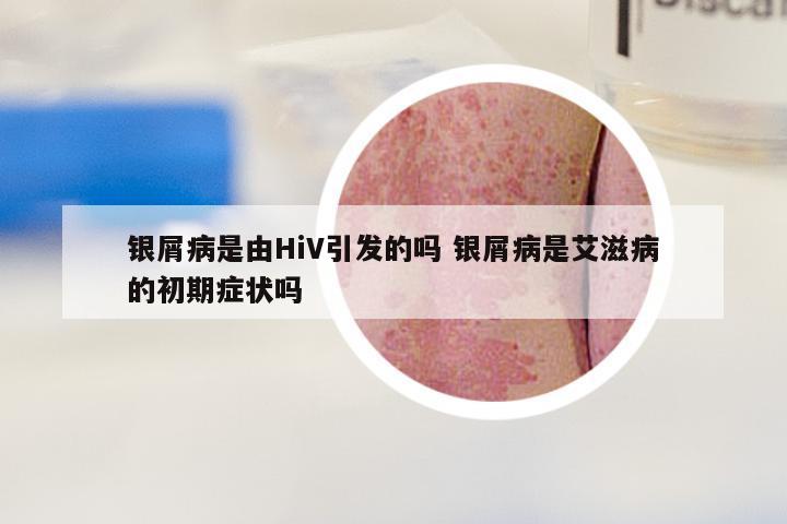银屑病是由HiV引发的吗 银屑病是艾滋病的初期症状吗
