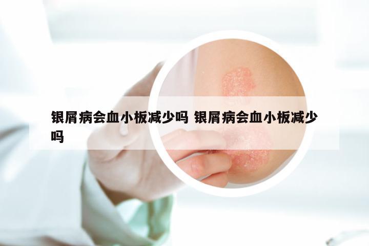 银屑病会血小板减少吗 银屑病会血小板减少吗