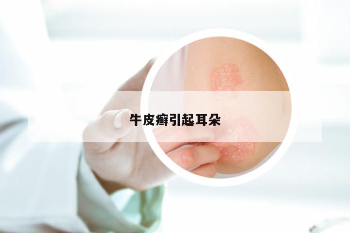 牛皮癣引起耳朵