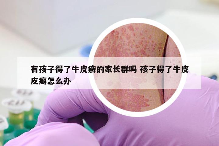 有孩子得了牛皮癣的家长群吗 孩子得了牛皮皮癣怎么办