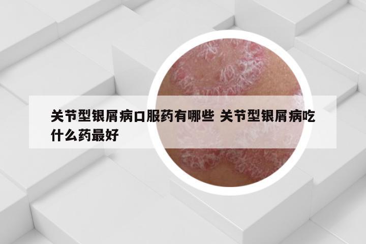 关节型银屑病口服药有哪些 关节型银屑病吃什么药最好