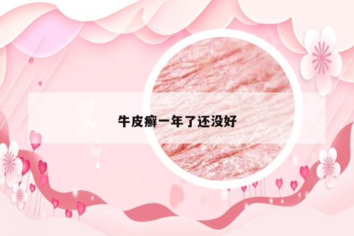 牛皮癣一年了还没好