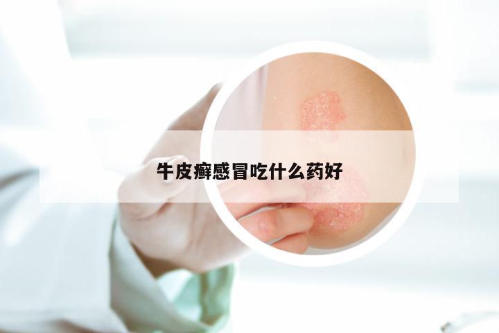 牛皮癣感冒吃什么药好