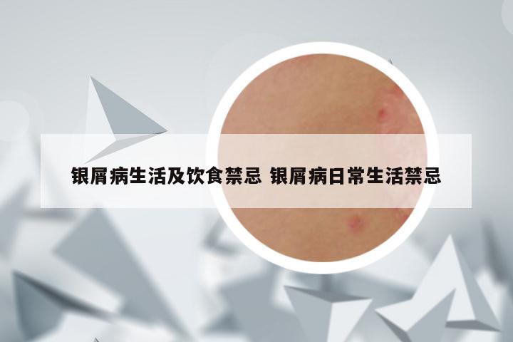 银屑病生活及饮食禁忌 银屑病日常生活禁忌