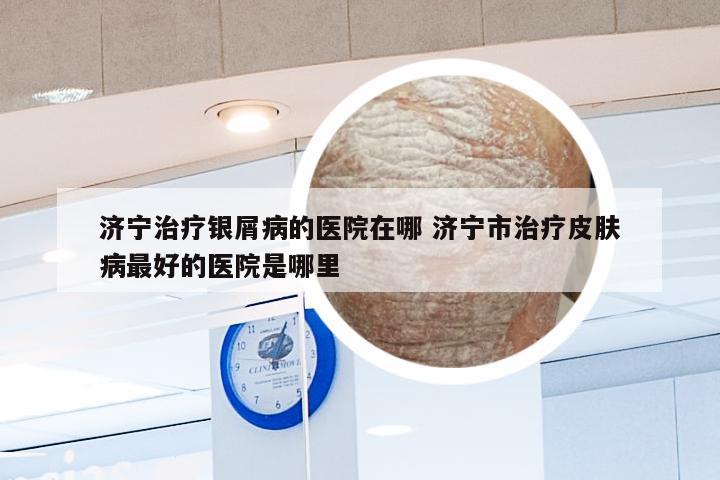 济宁治疗银屑病的医院在哪 济宁市治疗皮肤病最好的医院是哪里