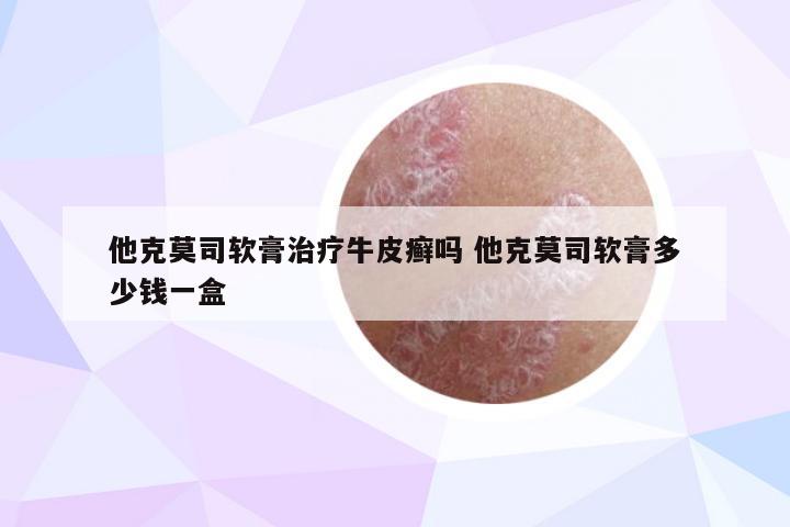 他克莫司软膏治疗牛皮癣吗 他克莫司软膏多少钱一盒