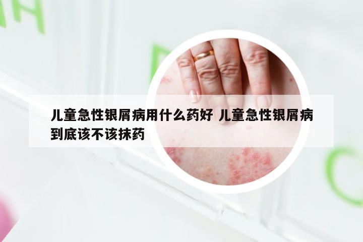 儿童急性银屑病用什么药好 儿童急性银屑病到底该不该抹药