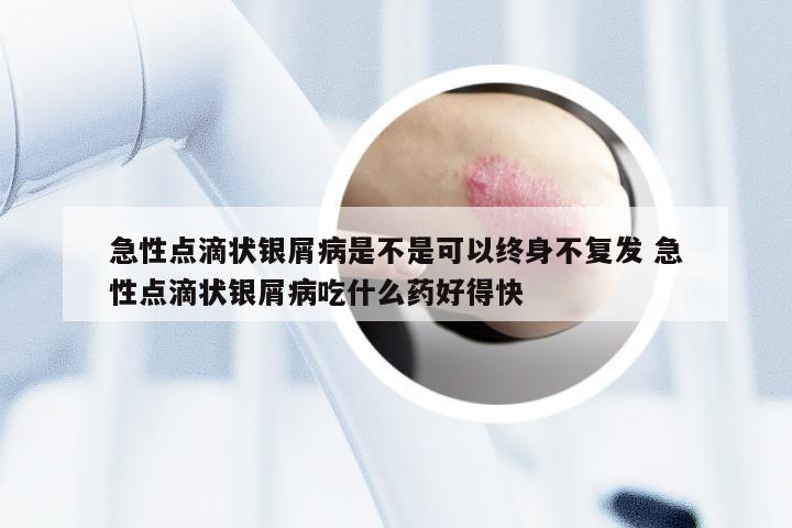 急性点滴状银屑病是不是可以终身不复发 急性点滴状银屑病吃什么药好得快