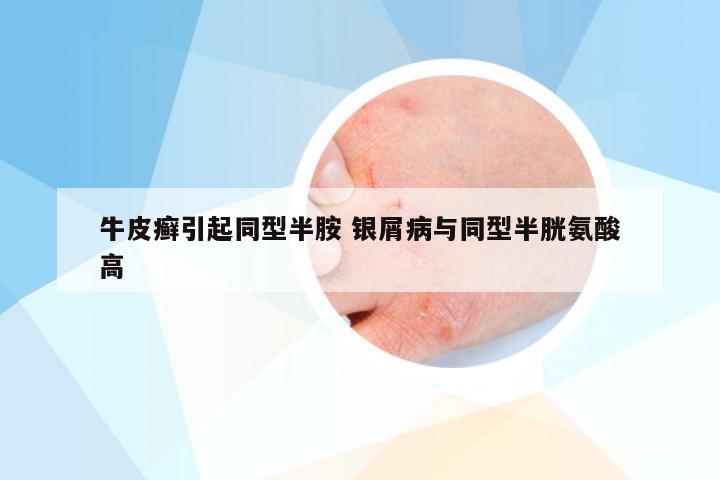 牛皮癣引起同型半胺 银屑病与同型半胱氨酸高