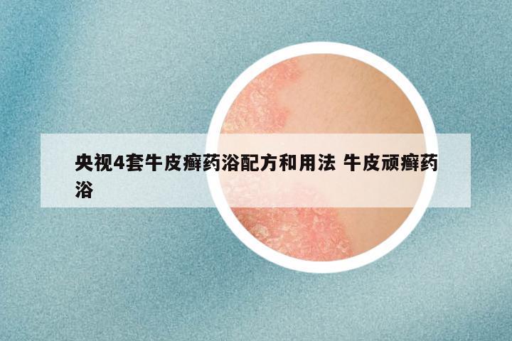 央视4套牛皮癣药浴配方和用法 牛皮顽癣药浴