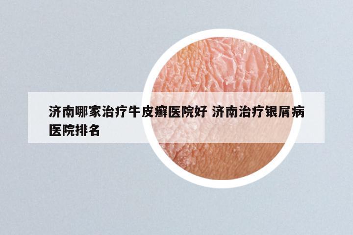 济南哪家治疗牛皮癣医院好 济南治疗银屑病医院排名