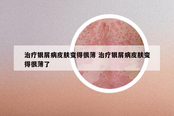治疗银屑病皮肤变得很薄 治疗银屑病皮肤变得很薄了