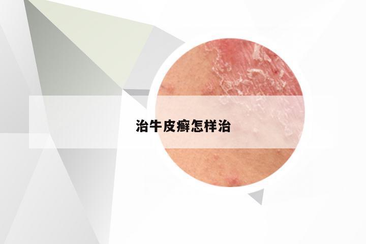 治牛皮癣怎样治