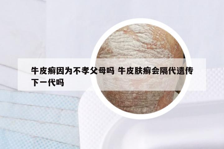 牛皮癣因为不孝父母吗 牛皮肤癣会隔代遗传下一代吗