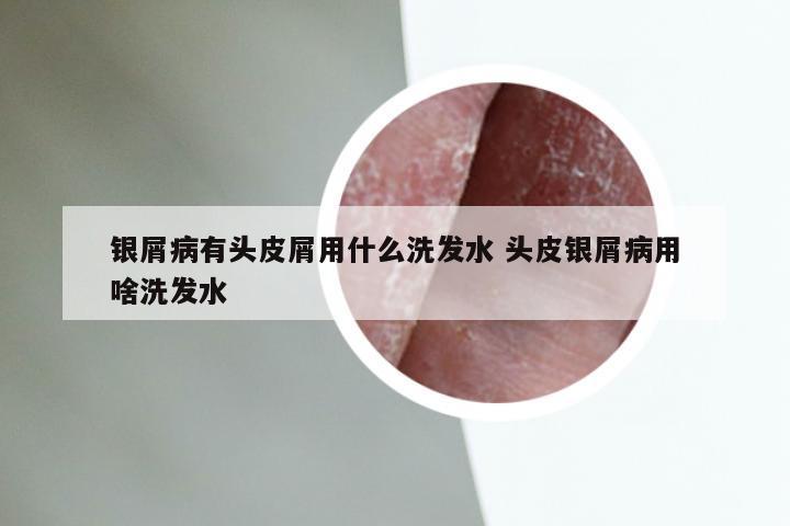 银屑病有头皮屑用什么洗发水 头皮银屑病用啥洗发水