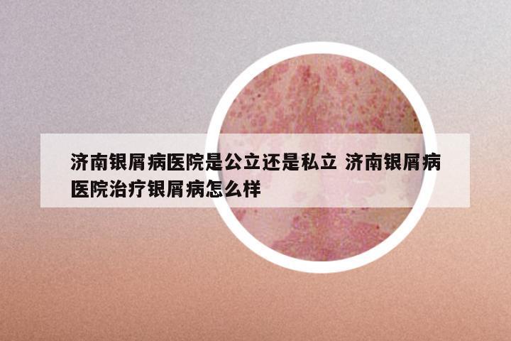 济南银屑病医院是公立还是私立 济南银屑病医院治疗银屑病怎么样