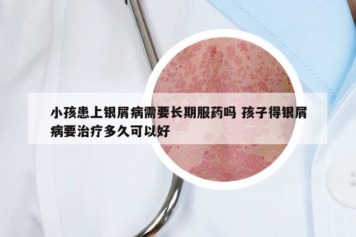 小孩患上银屑病需要长期服药吗 孩子得银屑病要治疗多久可以好