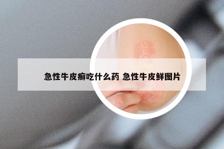 急性牛皮癣吃什么药 急性牛皮鲜图片
