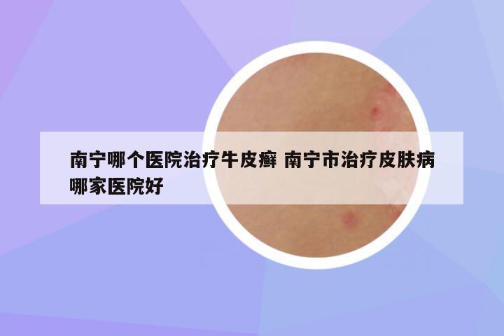 南宁哪个医院治疗牛皮癣 南宁市治疗皮肤病哪家医院好