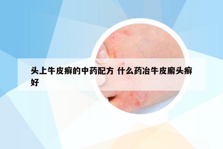 头上牛皮癣的中药配方 什么药冶牛皮廨头癣好