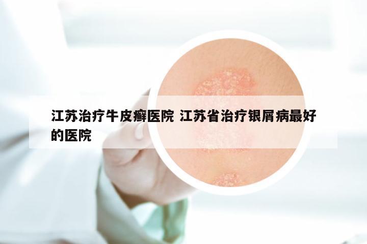 江苏治疗牛皮癣医院 江苏省治疗银屑病最好的医院