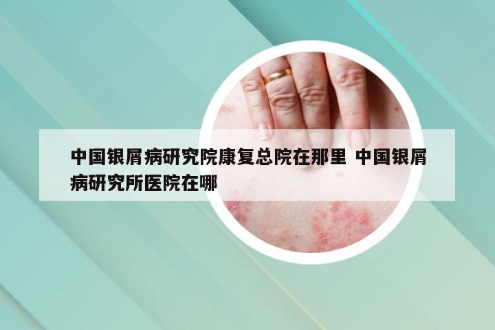 中国银屑病研究院康复总院在那里 中国银屑病研究所医院在哪