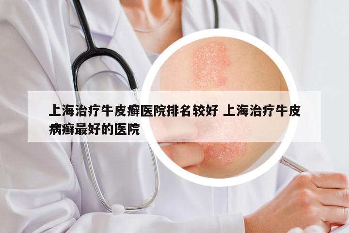 上海治疗牛皮癣医院排名较好 上海治疗牛皮病癣最好的医院