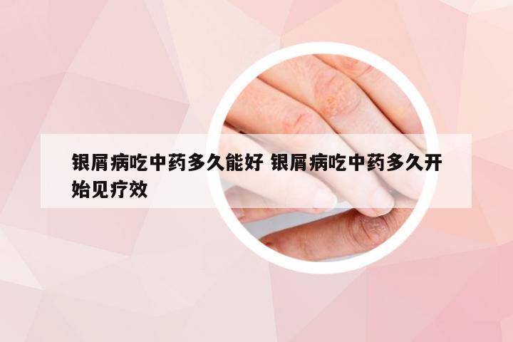 银屑病吃中药多久能好 银屑病吃中药多久开始见疗效