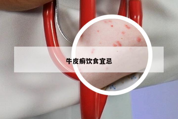 牛皮癣饮食宜忌